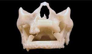 仁心仁術和3D打印技術幫助布拉辛馬克維拉重新綻放笑容